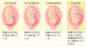 前置胎盤原因|前置胎盤の原因、確率、出産リスク、判明時期 治る？繰り返。